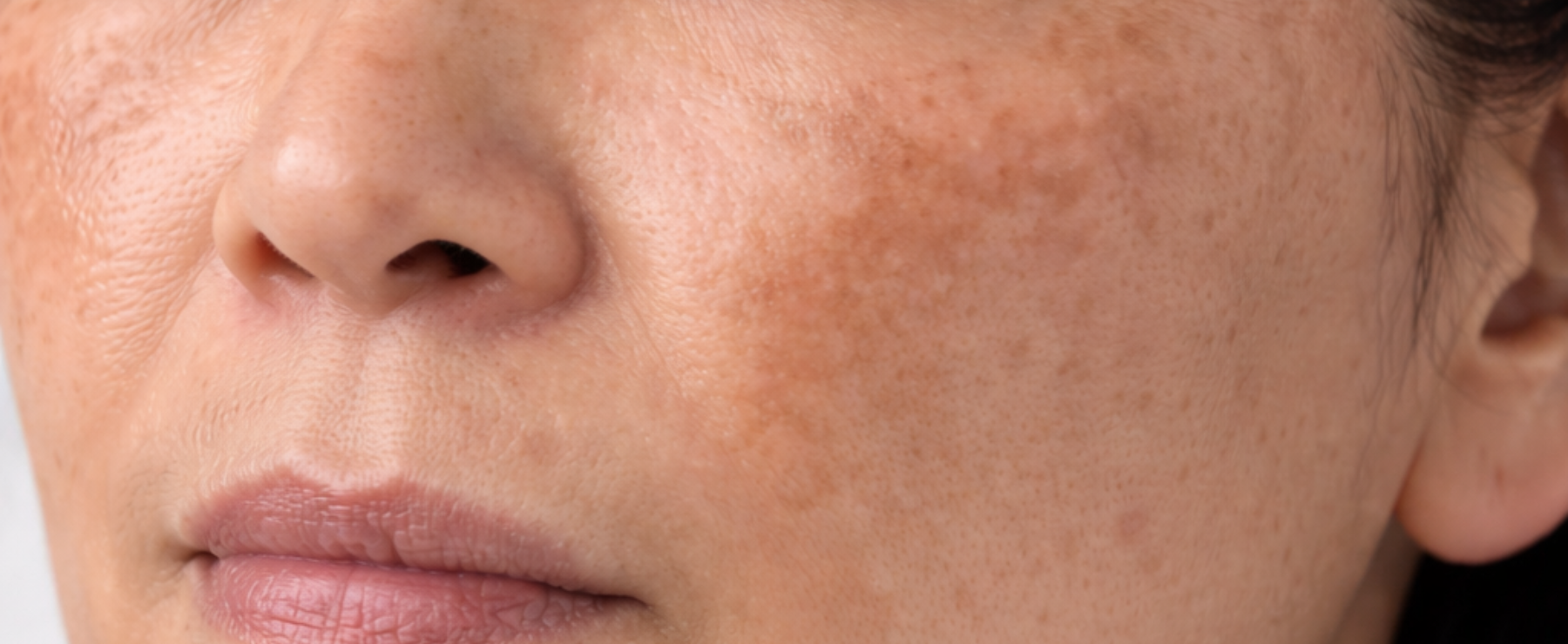 Taches pigmentaires & soleil : pourquoi tout se joue avant l’été ?