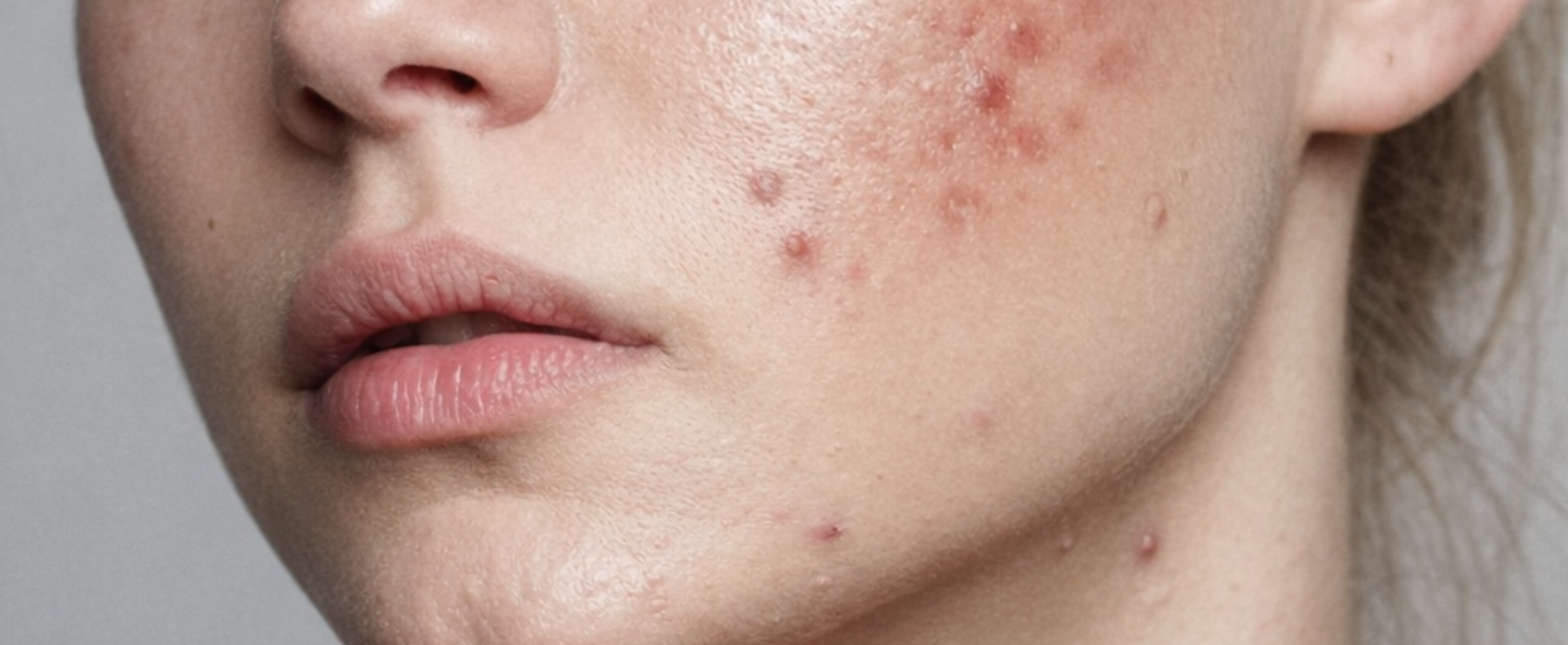 Acné hormonale : comprendre, apaiser, rééquilibrer