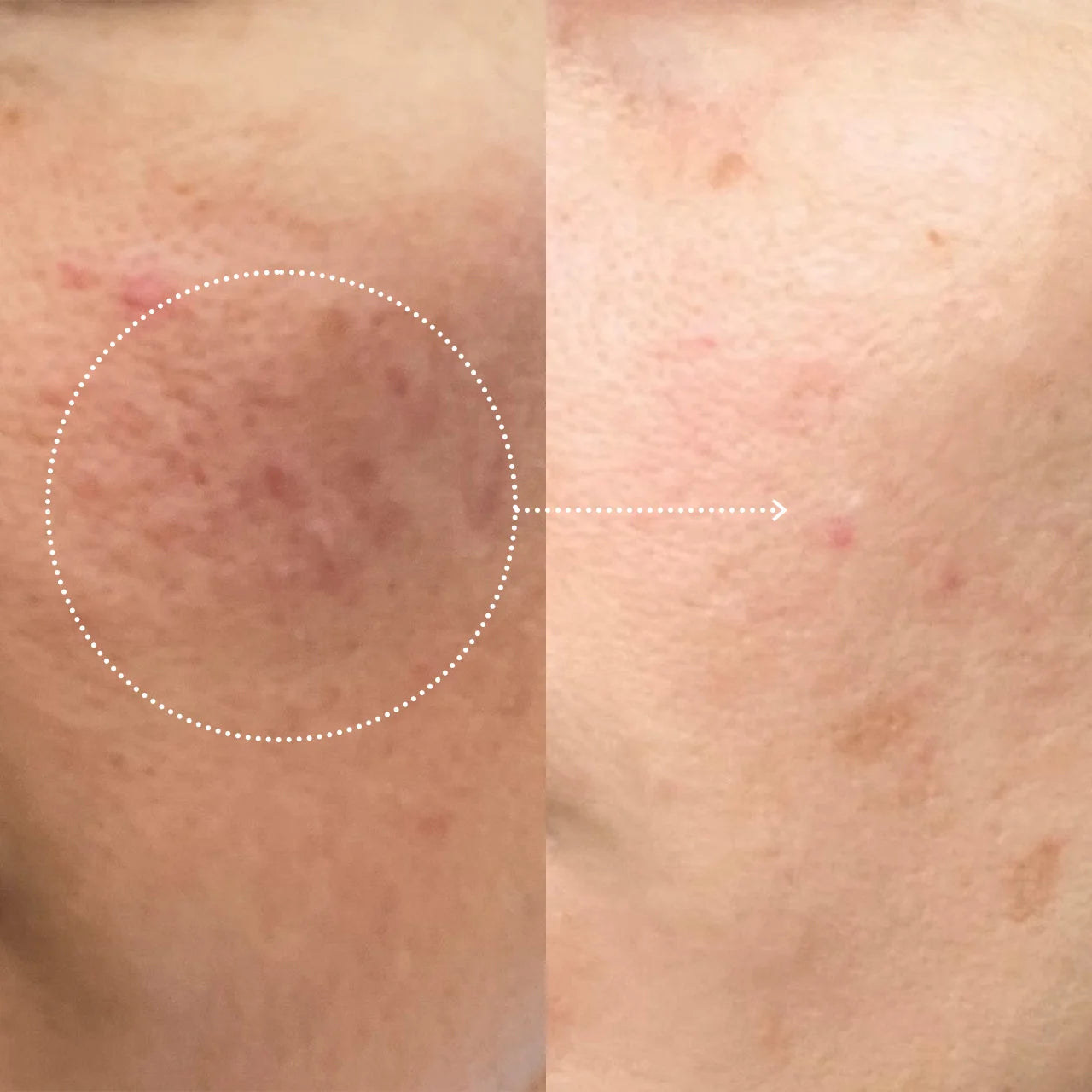 Résultat avant après de la crème visage lissante ultra hydratante Ad CAELIA, peau lissée et éclatante